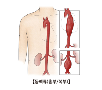 복부대동맥류