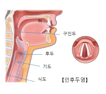 인후두염