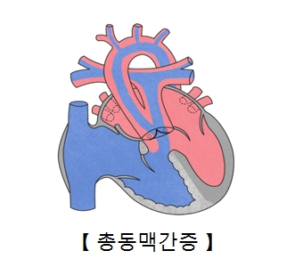 대동맥궁 단절