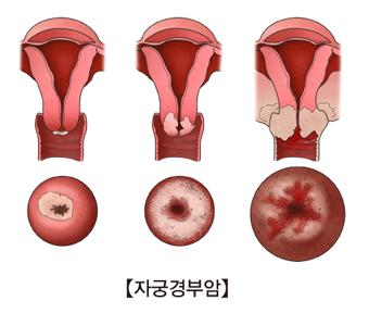 자궁경부암 이미지